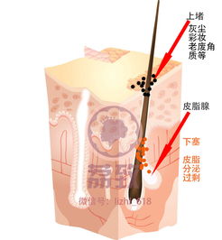 闭口怎么形成的 怎么去 