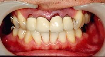 牙龈萎缩怎么改善 不要让牙齿孤独终生 