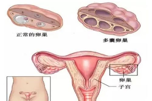 北京不孕不育医院 多囊卵巢能怀孕吗 影响怀孕真正的原因是什么