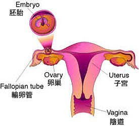 做试管婴儿可以避免宫外孕吗