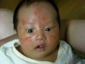 婴儿太热容易湿疹,天气太热婴儿会不会长湿疹