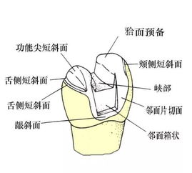 高嵌体的牙体预备步骤