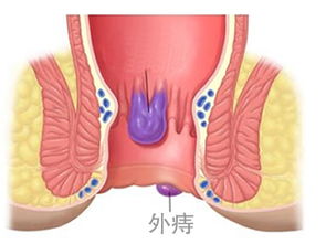 静脉曲张性外痔手术治疗的方法和费用