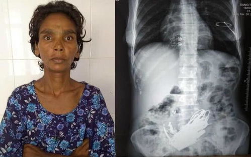 印度女子腹痛难忍去医院治疗,医生做手术取出3斤金属物惊呆众人