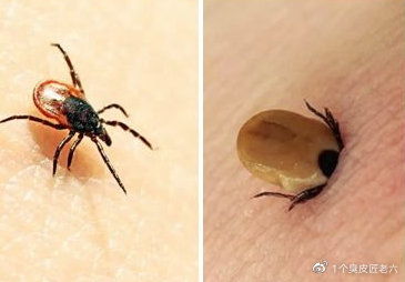 7月来南京收治5例蜱虫叮咬重症患者 万一被咬,如何处理 怎么预防