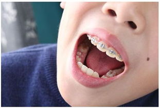 孩子牙齿不平整怎么办 这些好方法帮你矫正它