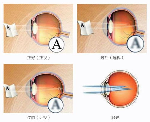 提醒 不近视的预防近视,已经近视的控制近视度数加深,避免成高度近视 屈光 