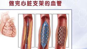 颈动脉斑块别乱治 专家五脏同调消斑块,不支架 不搭桥