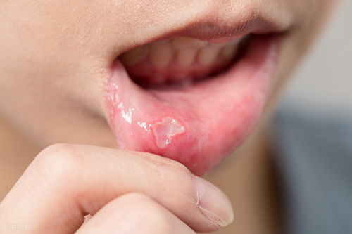 嘴巴长期长口腔溃疡怎么办