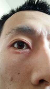 眼角红肿是怎么回事 