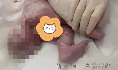 怀孕5个月突然发现腹中胎儿有条 尾巴 ,夫妻俩慌了,结果