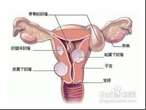 子宫肌瘤诊断需要做哪些检查 