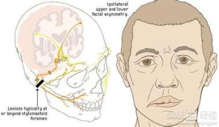 病毒型面瘫怎样治疗更安全