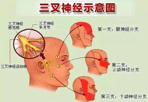 三叉神经痛可以治愈吗(三叉神经痛怎么治疗)