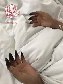 女子手指蹭破小口后感染 致 8 根手指突变 枯树枝