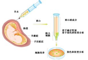 羊水穿刺结果(羊水穿刺结果怎么看)