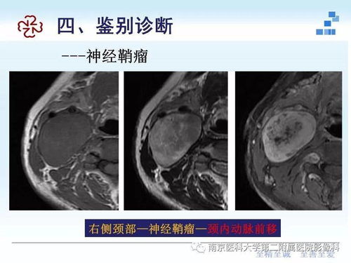 腮腺混合瘤的影像诊断与鉴别