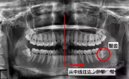 拔水平阻生全埋伏智齿的过程和感受是怎样的