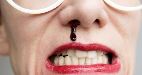 冷静 流鼻血时,这4个方法能快速止血 不是仰头