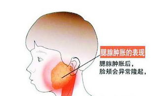 腮腺炎是什么症状