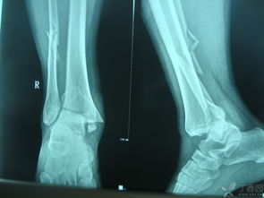 三踝骨折急诊复位钢板固定治疗