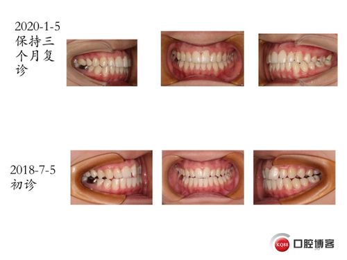 2020 1 一例牙齿不齐的矫正