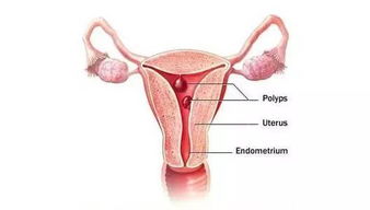 子宫内膜息肉 影响怀孕吗 
