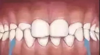 牙齿需尽早矫正的 9大信号