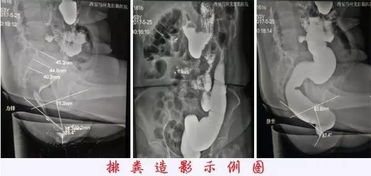 排粪造影痛苦吗 来来来,刷新下你的三观