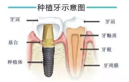 种牙痛不痛,种植牙是不是很疼