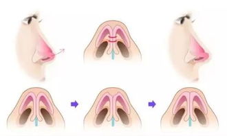 哪几种情况最适合做鼻头整形手术