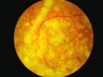 色素性视网膜炎,色素性视网膜炎可以治好吗