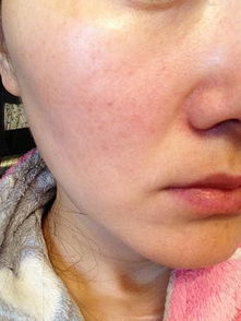脸过敏了红痒有什么办法最快消除？脸部过敏发红发痒怎么快速消除