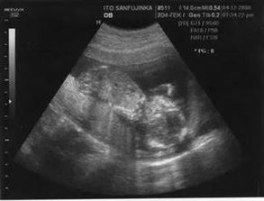 怀孕初期b超没有胚芽正常吗,孕妇初期没有胎芽怎么回事?