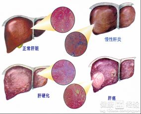 初期肝硬化应注意什么