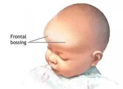 宝宝的头大 头小 偏头,方颅,是什么原因 一次性弄清楚