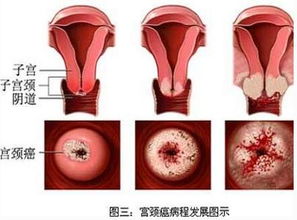 导致阴道不规则出血的原因是什么