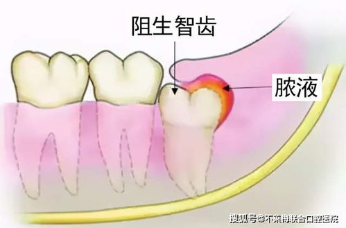 智齿被牙肉挡住的图片 搜狗图片搜索