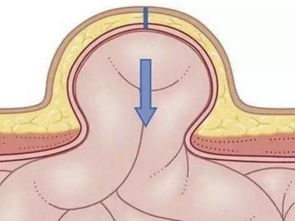 肚子鼓出个包块，为什么发生“疝气”时肠子可能坏死，会危及生命(肚子有气鼓包)