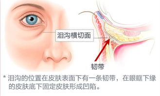 深圳阳光玻尿酸填充泪沟 告别苍老疲惫脸