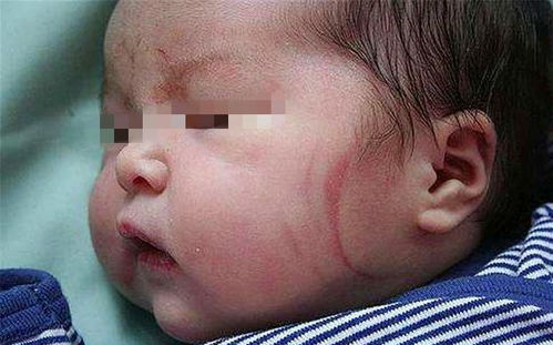 宝宝出生时脸被产钳划伤「娃出生后脸上产钳印不消宝妈找医生要状告反被医院看笑话」