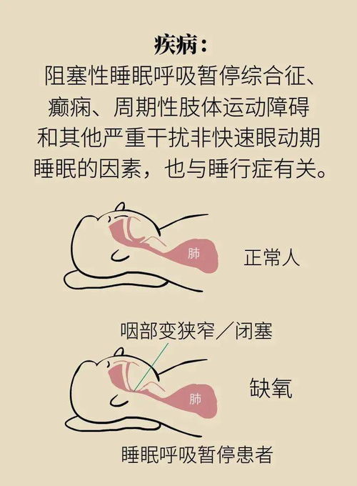 梦游的人被叫醒会变傻 答案是