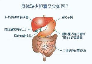 胆结石一定要切胆 黄洁夫说 70 患者是不需要