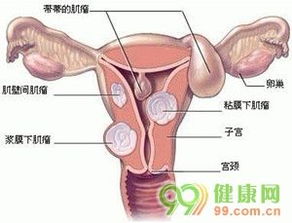 有子宫肌瘤能怀孕吗(50岁有子宫肌瘤能怀孕吗)