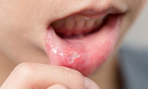 口腔溃疡反复发作,有可能会产生恶变