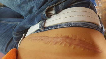 我肚子上有条缝过的疤痕,请问有什么长方形的纹身贴吗 