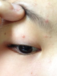 右眼皮上长了一颗痘痘,这是什么 