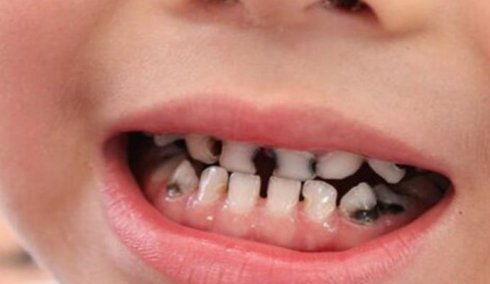 孩子没自信不合群原来与龋齿 蛀牙有关系 益生菌护齿去黑牙 