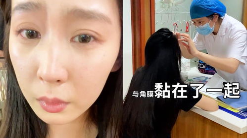 女生吃烧烤忘摘美瞳险些失明 美瞳被烤干变形与角膜黏在一起