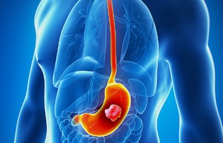 一文详解 晚期胃癌的治疗方法及进展